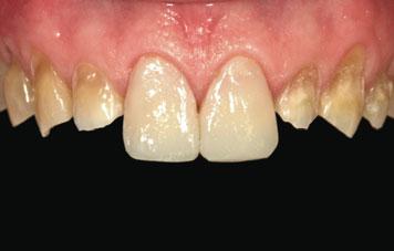 This avoided additional costs for the patient, and reduced the timescale involved (the treatment was an urgent priority for the patient, who had become extremely conscious of his smile).