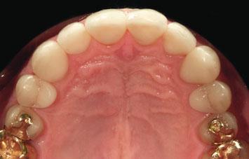 was made, into which each restoration could be built. Each tooth was restored individually under rubber dam (Fig 4).