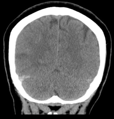 Non-contrast CT, axial view Non-contrast CT, coronal view Asymmetric hyperdensity of thrombus