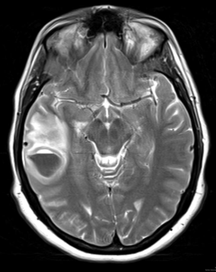 T2 AXIAL Acute/Hyperacute hematoma in the right temporal lobe with a hematocrit effect (yellow arrow).