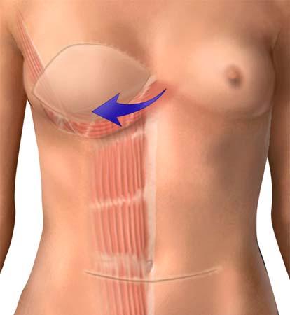 What is a breast reconstruction with abdominal tissue flap? A breast reconstruction is an operation to recreate a breast shape after you have had a mastectomy.