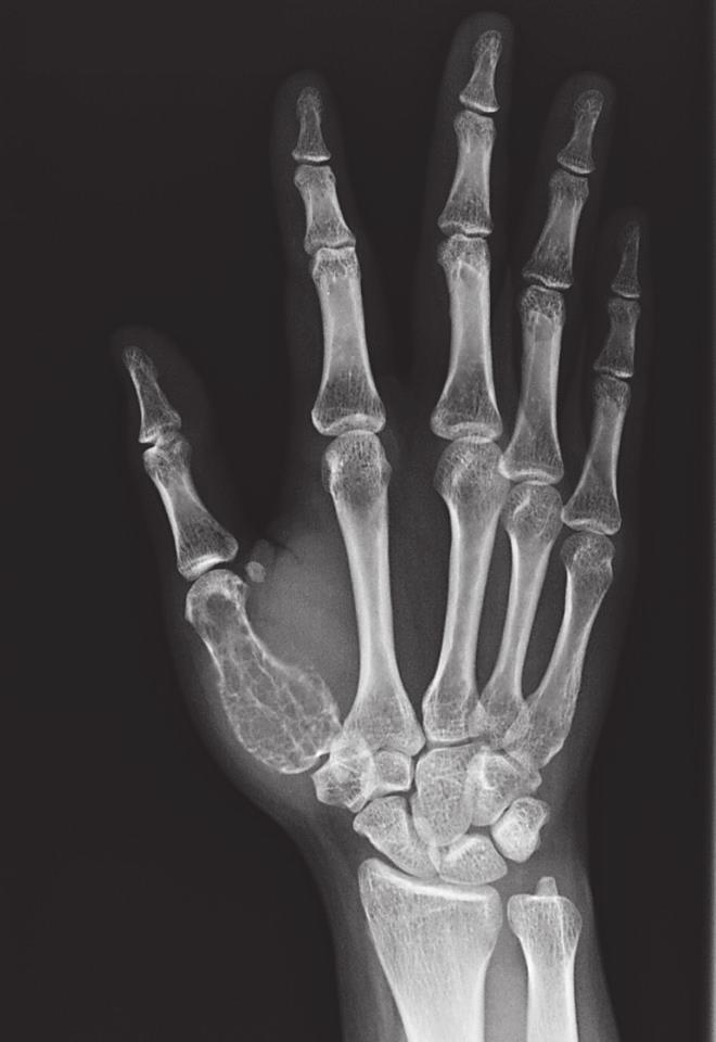 2 Case Reports in Orthopedics Figure 1: Plain radiograph showing expansile osteolytic lesion involving the entire length of the first metacarpal.