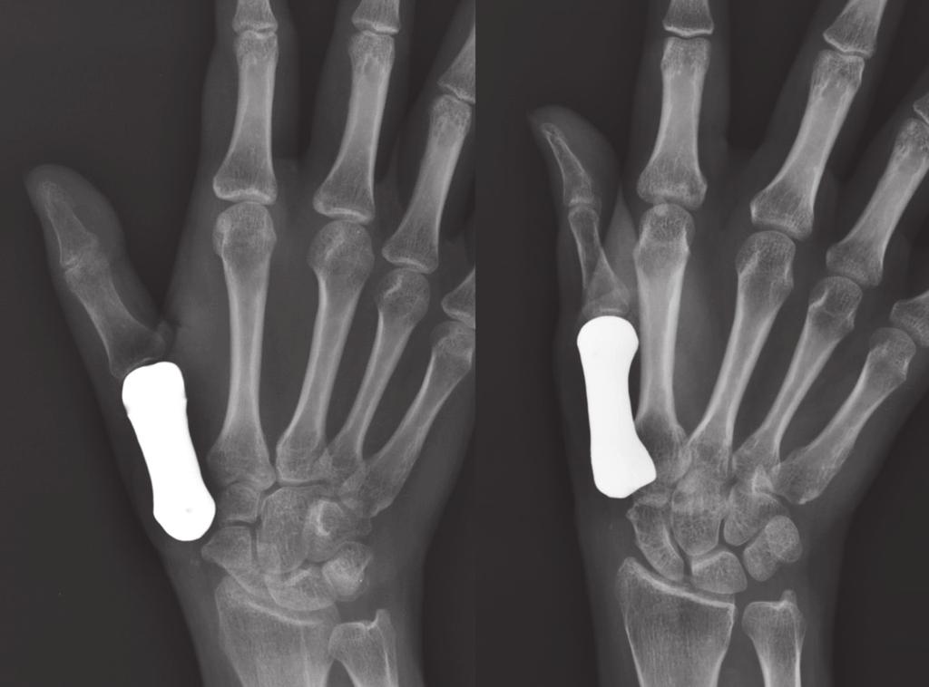 4 Case Reports in Orthopedics Figure 6: Plain radiographs of a patient-matched total first metacarpal prosthesis. prosthesis in an appropriate alignment.