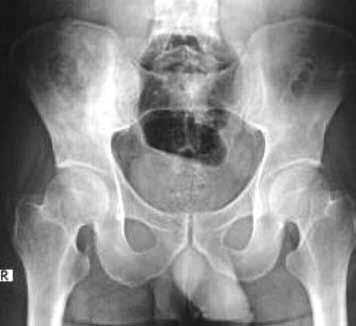 394 U. YDinli,. kesen, U. YlçinkY,. HkYEMEz, R. SERifOĞlU Massive resections in the ilium and the sacroiliac joint may lead to vertical and rotational instability.