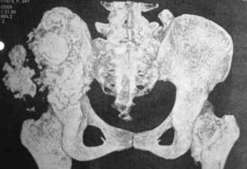 Patients were placed in lateral position. following prepping and draping, two incisions were made. The first incision was made from the SiS to the sacroiliac joint over the ilium.