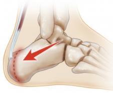 (Sever s Disease) Achilles tendon insertion Ages 7-13 5 th Metatarsal