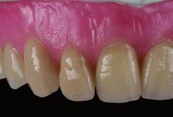 : 13) and through this it allows a naturally looking interdental modulations.