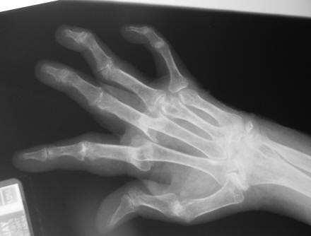 nodules Serum rheumatoid factor Radiographic changes Limitations of ACR Classification Criteria for the diagnosis of early RA