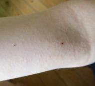 Ticks on people 6 year old child s arm This is the likeliest