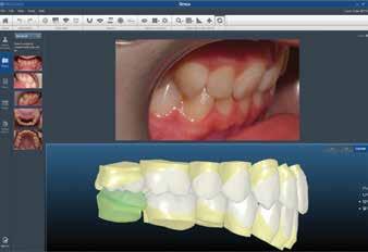 case presentation // feature Step 3: Ensure proper upper central incisor inclination The most esthetic position for the upper central incisor where light reflection upon smiling is at its best is for