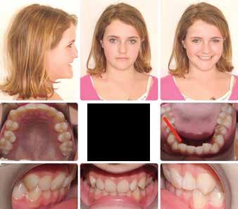 Case review This patient was 12 years, 9 months old, and presented with a Class I dental and skeletal occlusion, deep bite with moderate crowding in each arch and severely retroclined upper incisors
