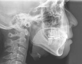 200 Issues in Contemporary Orthodontics Figure 12. Post-treatment lateral cephalometric radiograph. (Case 1) 13).