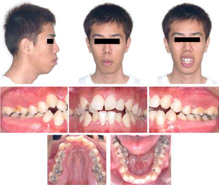 202 Issues in Contemporary Orthodontics Figure 15. Pretreatment facial and intraoral photographs. (Case 2) The lateral cephalometric radiograph showed severe facial and skeletal problems (Figure 16).