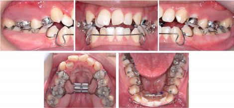 204 Issues in Contemporary Orthodontics remained in place for an additional 3.5 months during the completion of mandibular expansion (Figure 19). Figure 17.