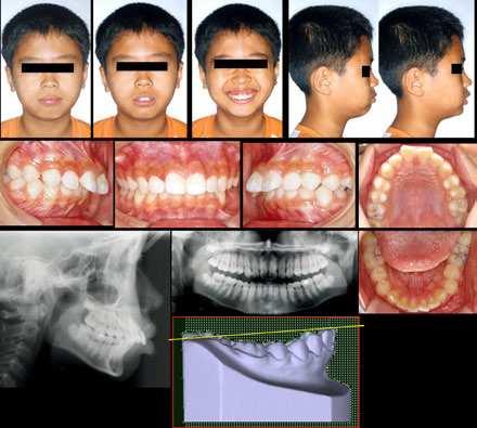 210 Issues in Contemporary Orthodontics After 13 months of retention, as a result of relapse due to extrusion of the maxillary anterior and posterior teeth, the FMA, ANB angle, and anterior facial