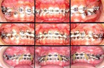 212 Issues in Contemporary Orthodontics The second option would provide good results with minimum patient compliance. Therefore, this treatment plan was chosen. 3.