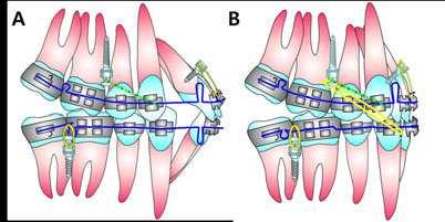 192 Issues in Contemporary Orthodontics Figure 2. A.Denture correction : A mandibular.019.025 closing loop archwire and a maxillary.020.025 closing loop archwire are fabricated.