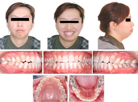 194 Issues in Contemporary Orthodontics 3. Case report 3.1. Case 1. skeletal class II with lip protrusion, gummy smile and asymmetry [18] 3.1.1. Diagnosis A 23-year old woman presented with the chief complaints of lip protrusion and gummy smile.