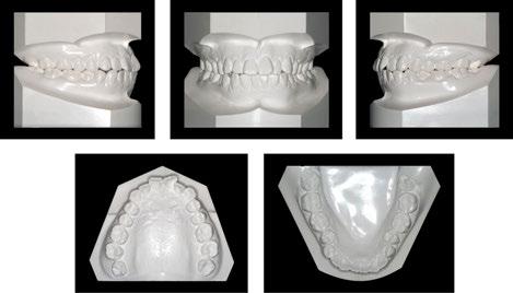 A New Protocol of Tweed-Merrifield Directional Force Technology Using Micro-Implant Anchorage (M.I.A.) http://dx.doi.org/10.5772/60106 195 Figure 6. Pretreatment dental casts.