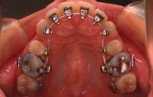 Lower Occlusal INTRA-ORAL