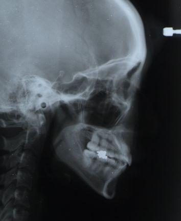 LATERAL SKULL RADIOGRAPH AT COMPLETION OF TREATMENT CANDIDATE