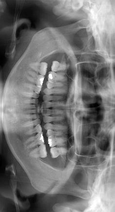 PERIAPICAL OR PANORAMIC RADIOGRAPH AT RETENTION / POSTRETENTION