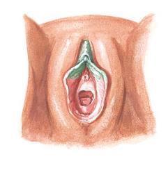 Types of FGM Type 2 Excision Excision: partial or total removal of the Clitoris and the labia