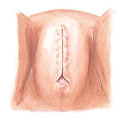 Types of FGM Type 3 Infibulation Infibulation: narrowing of
