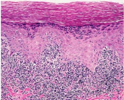 Figure 5: Showing Lichen planus with dense band-like infiltrate predominantly of lymphocytes in the papillary dermis that extends to the epidermis, where there is vacuolar alteration of the basal