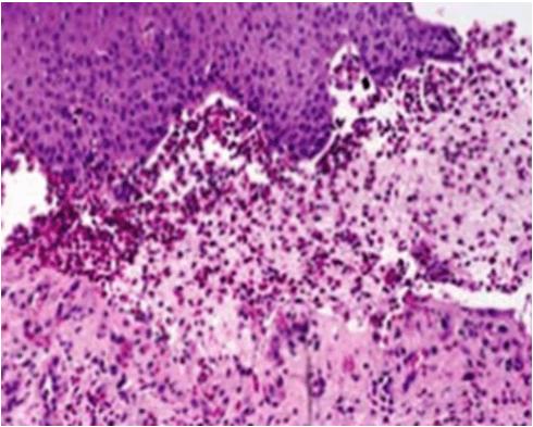 Acantholysis has extended into adnexal structures and stratum spinosus. This was a retrospective study carried out at the department of Pathology B.J.