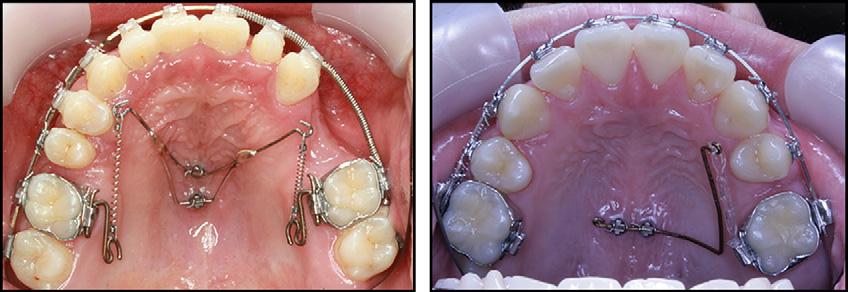 possible to perform multidirectional tooth movements simultaneously, such as intrusion and distalization.