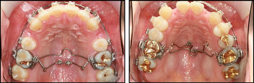 884 Kang, Kim, and Nam Fig 7. Intrusion of the maxillary posterior teeth.