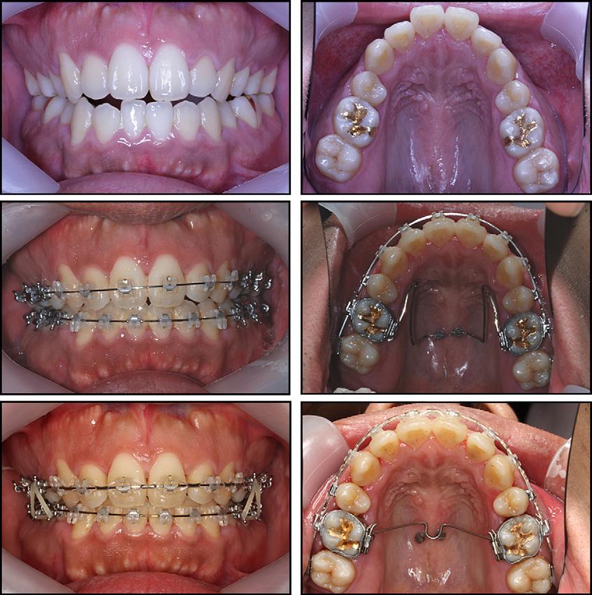 Simultaneous bilateral expansion and intrusion of the maxillary posterior teeth: upper, initial status of narrow maxillary arch with anterior open bite; middle, intrusion and expansion activated