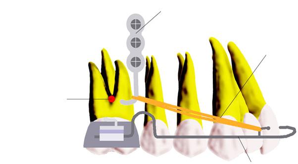 After fixation, the incision site is closed and sutured. The free intraoral parts of the miniplates are bent distally into hooks. The inner-bow is made from stainless steel wire, 1.