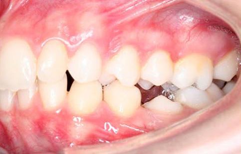 The dental cast analysis showed 2 mm of space deficiency in the upper arch, 1.