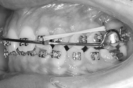 She chose orthodontic eruption of the impacted canines with the nonextraction approach, and informed