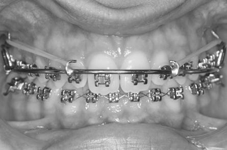Zygoma-gear appliance for intraoral upper molar distalization After the leveling phase, the retained