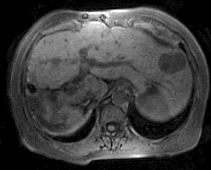 215 Fig. 2. MRI of the liver.