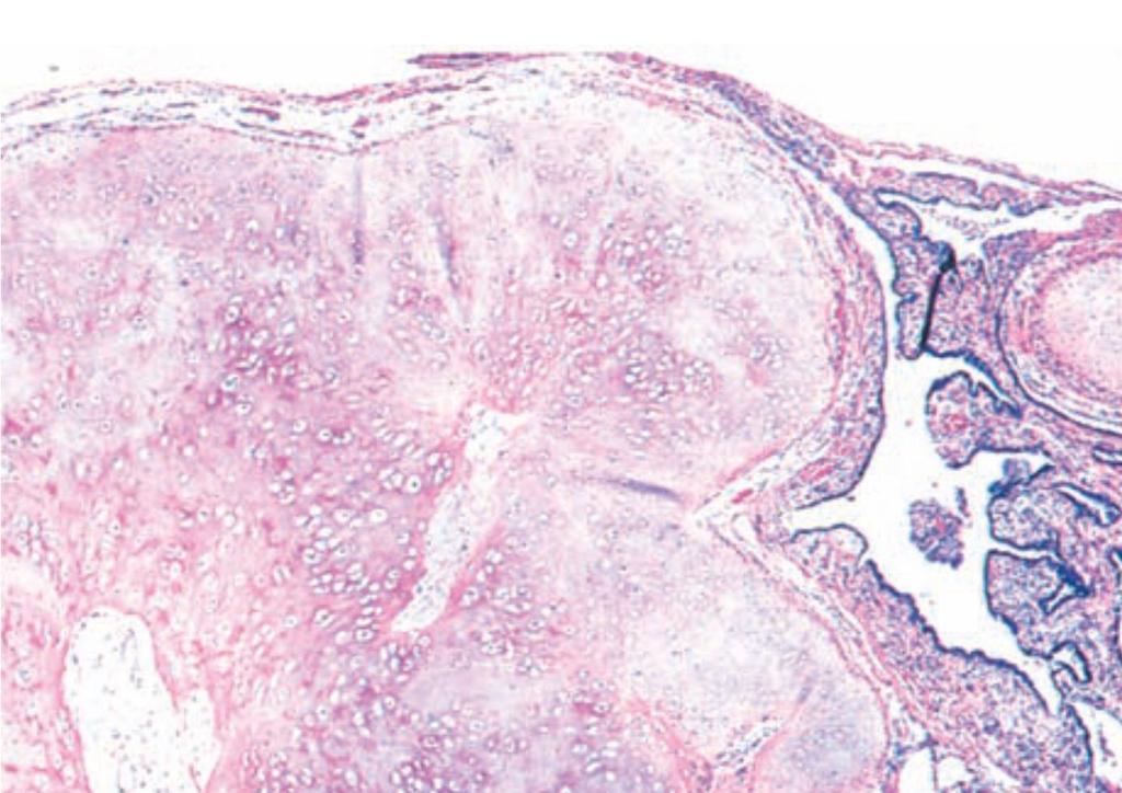 Quiz A) A 56-year-old man with a history of cigarette smoking presents with difficulty swallowing and a muffled voice. Laryngoscopy reveals a 2-cm laryngeal mass.