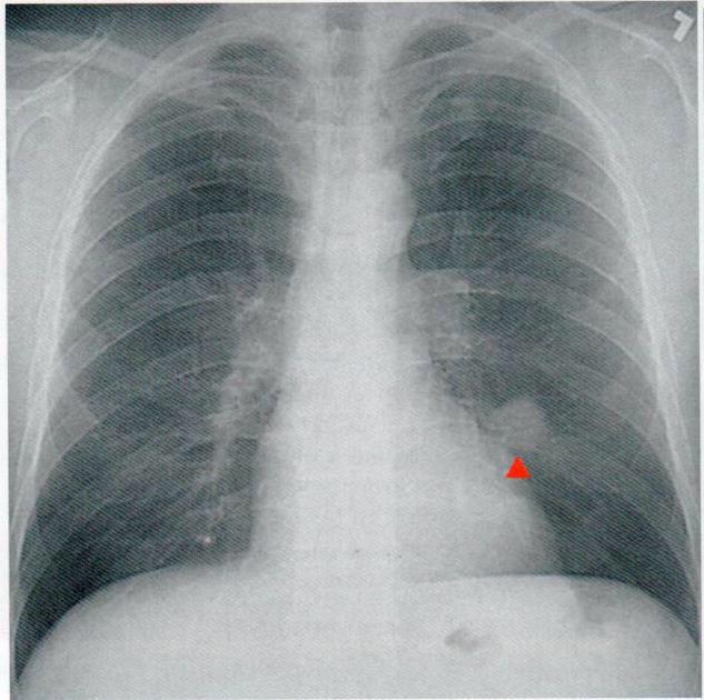 of age. General: 1- Unexplained weight loss 2- Unexplained anemia 3-Unexplained fever (usually lymphoma) 4-Unexplained fatigue Lung-specific: 1-Unexplained cough. 2-Hemoptysis.