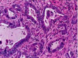 Etiology Morphology Clinical features Most frequent histologic subtype of bronchogenic carcinoma; more common in women, & patients