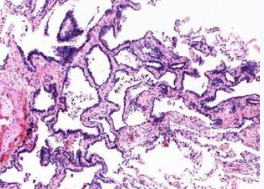 line the alveoli (along the basement membrane hyperplasia)