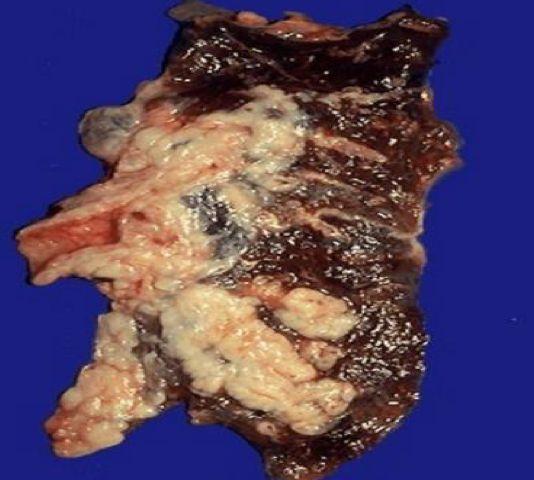 2- Small cell carcinomas Epidemiology Treatment Prognosis Also known as: oat cell carcinoma Type of poorly differentiated neuroendocrine tumors arising from neuroendocrine