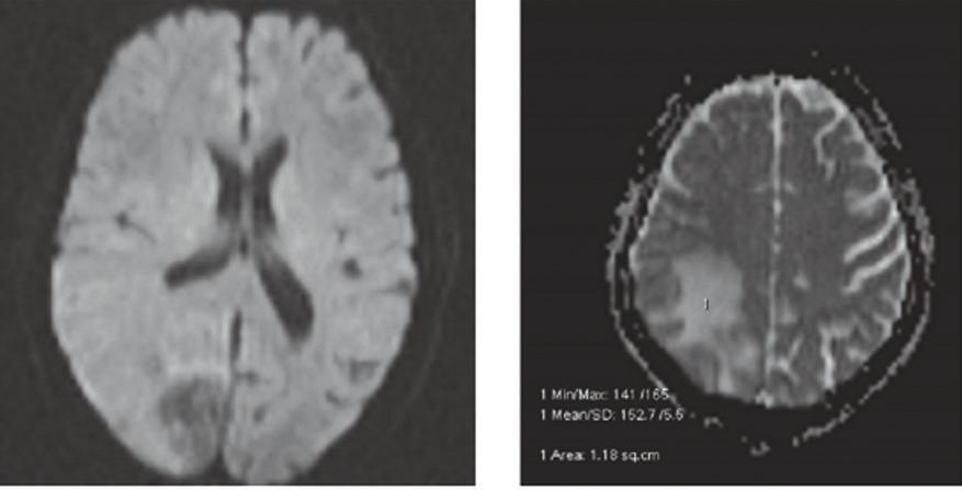 Note that the corpus callosum (arrow on left image) is hypointense when the gradient is applied in the x (right-to-left) direction, the frontal and posterior white matter (arrowheads) are hypointense