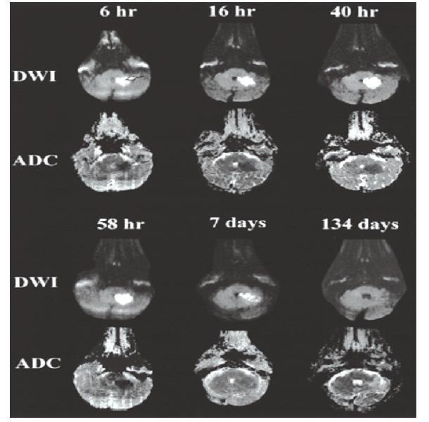 Figure 5: COMPARING DWI AND FLAIR IMAGES IN ACUTE INFARCT. In chronic infarcts the signal on DWI and ADC images is variable and depends on a combination of T2 signal and increased ADC values.