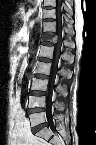 Pain Physician: July/August 2012; 15:E527-E532 (3-5). However, there have been no studies reporting acute compression fractures of an adjacent vertebra immediately after PV.