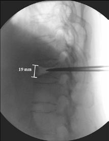 (B) Intraoperative lateral image of C-arm fluoroscopy showing cannula induces reduction of collapsed T12