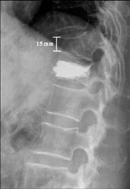 (C) Radiographic image obtained 4 hours after the percutaneous vertebroplasty showing reduction of the T12
