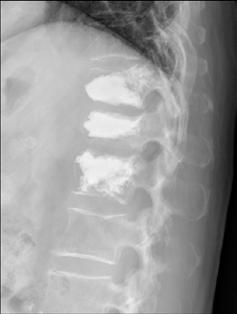 (B) Postoperative radiographic image showing cement within T11, T12, and L1.