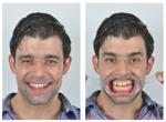 The 4 views of DSD To have a 3 dimensional understanding of the dento-facial relationship through 2 dimensional photos we analyze 6 photos in 4 specific angles: -Frontal Facial (retracted and smile)